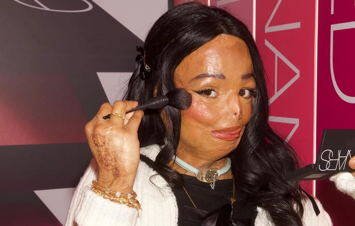 Γυναίκα εγκαυματίας μετά τη χρήση σαμπουάν για ψείρες! ΦΩΤΟ 25 Γυναίκα εγκαυματίας μετά τη χρήση σαμπουάν για ψείρες! ΦΩΤΟ