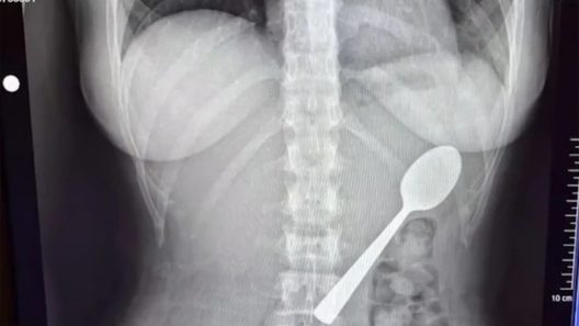 Η ακτινογραφία που «έδειξε» κουτάλι στο σώμα γυναίκας