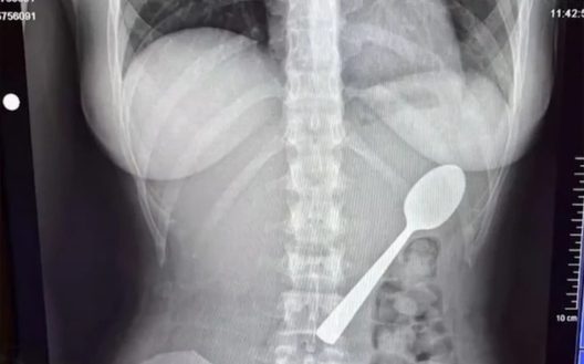 Η ακτινογραφία που «έδειξε» κουτάλι στο σώμα γυναίκας