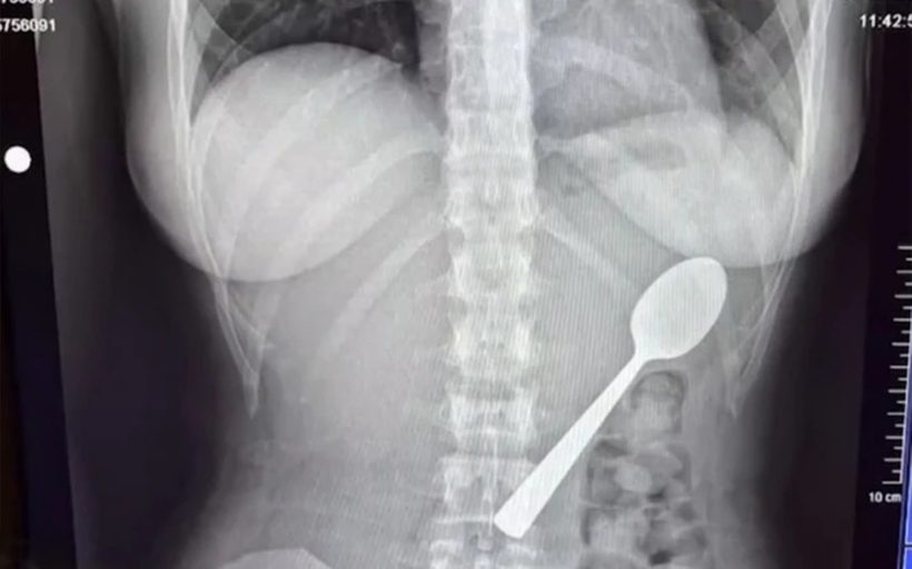 Η ακτινογραφία που «έδειξε» κουτάλι στο σώμα γυναίκας