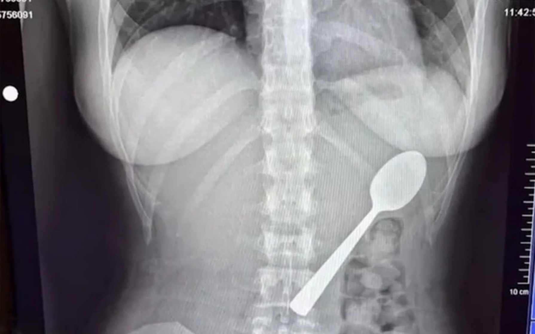 Δεν πίστευαν αυτό που «βρήκαν» γιατροί στο Βέλγιο