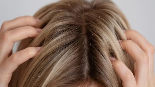 Γυναίκα εγκαυματίας μετά τη χρήση σαμπουάν για ψείρες! ΦΩΤΟ