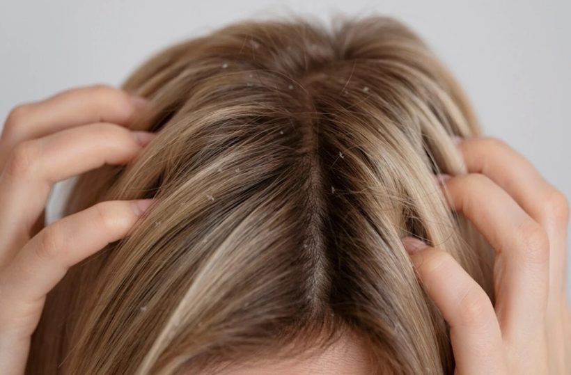 Γυναίκα εγκαυματίας μετά τη χρήση σαμπουάν για ψείρες! ΦΩΤΟ 24 Γυναίκα εγκαυματίας μετά τη χρήση σαμπουάν για ψείρες! ΦΩΤΟ