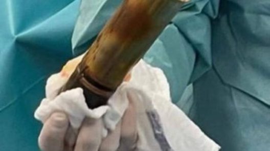 Το βλήμα που «σφηνώθηκε» στον άνδρα