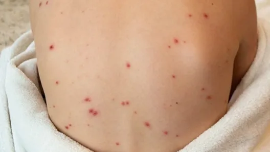 Κώδωνας κινδύνου από τον ΕΟΔΥ για την ιλαρά