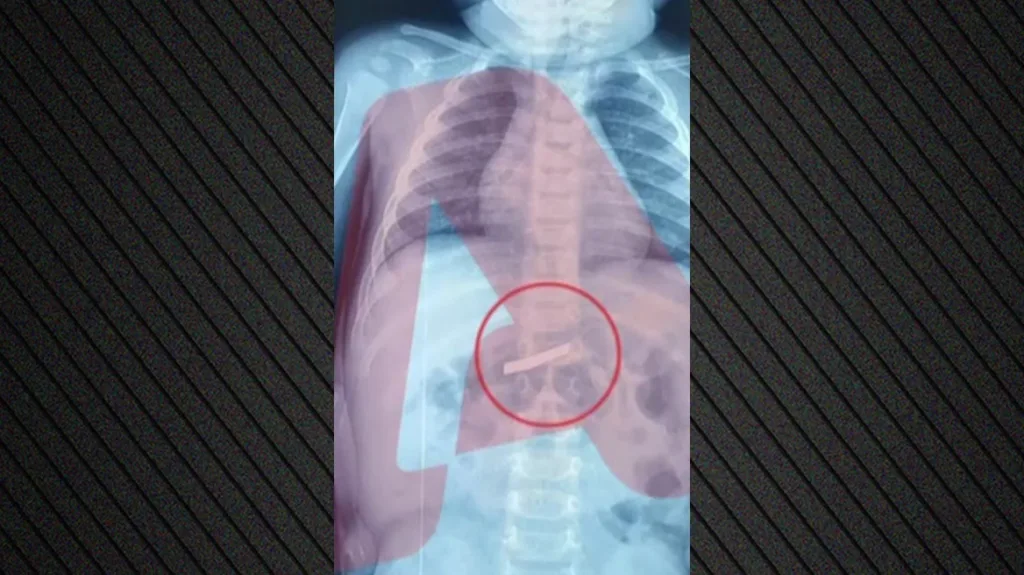 Εσπευσμένα στο Παίδων 3χρονος που κατάπιε ξυραφάκι, ποια η κατάσταση του ΦΩΤΟ