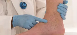 Θρόμβωση: 7 «σιωπηλά» σημάδια που δεν πρέπει να αγνοήσετε