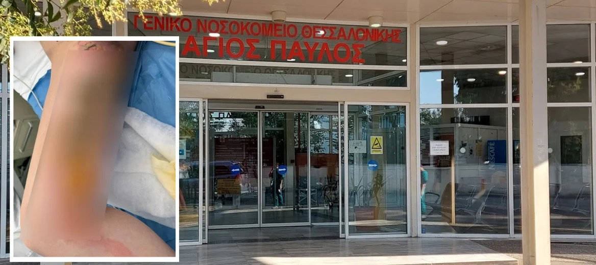Θεσσαλονίκη: Μπήκε στο νοσοκομείο για αφαίρεση κύστης κόκκυγα και κατέληξε με εγκαύματα