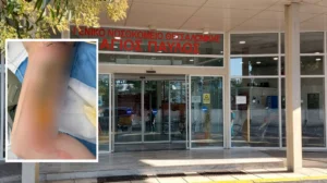 Θεσσαλονίκη: Μπήκε στο νοσοκομείο για αφαίρεση κύστης κόκκυγα και κατέληξε με εγκαύματα