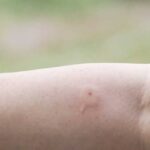 Εύβοια: Ανδρας πέθανε από τσίμπημα σφήκας